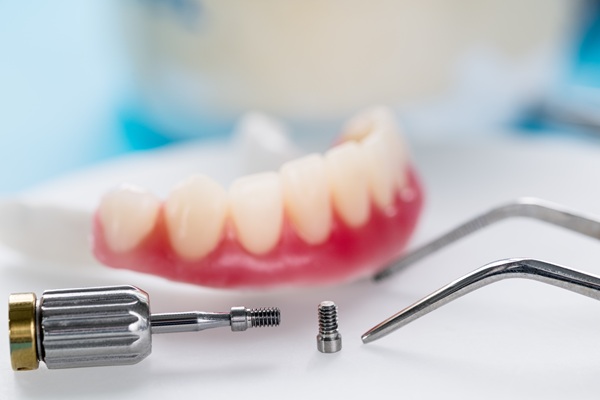 What Is The Process Of Getting All On   Implants?