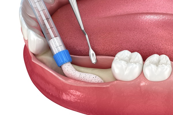 Reasons For A Bone Graft Procedure For Dental Implants