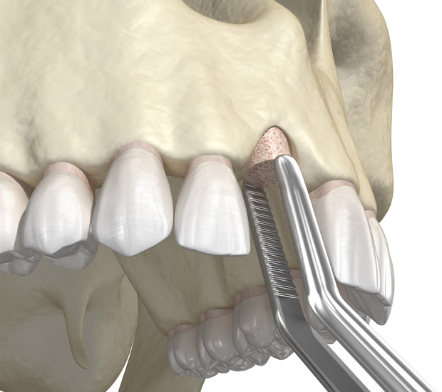 Cypress Bone Grafting for Dental Implants