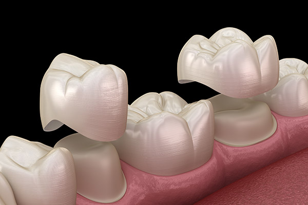 Crown Lengthening Procedure from a Periodontist from Charles E. Dyer IV, DDS, MS, PC in Cypress, TX