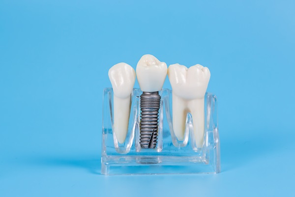 The Benefits Of Getting Dental Implants From A Periodontist