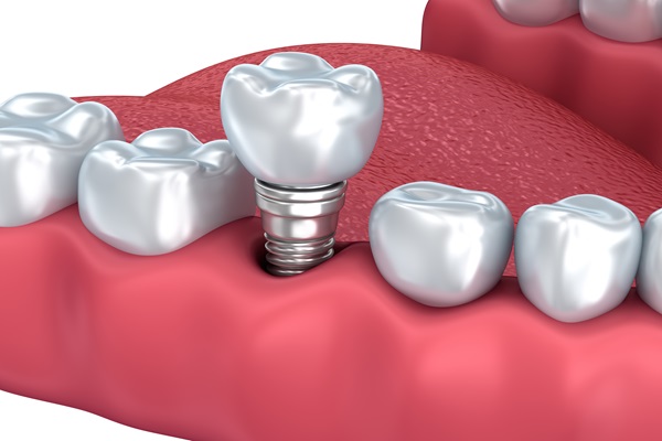 A Permanent Solution: Understanding Dental Implants