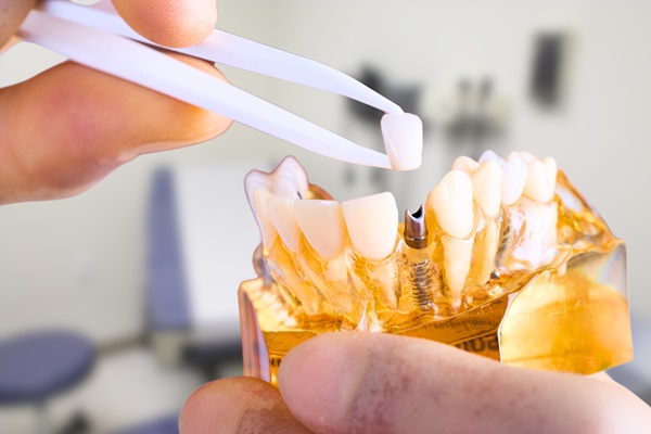 Caring For Your Dental Implants: Tips For Maintaining Oral Health