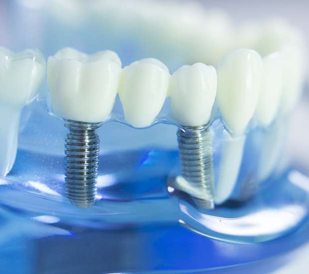 Cypress Dental Implants
