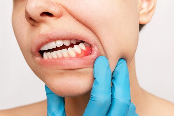Common Causes Of Gum Disease