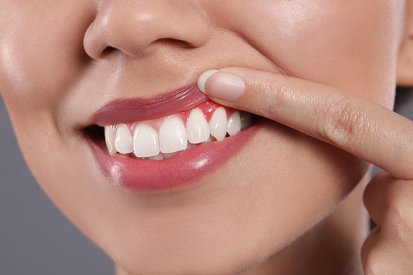 Reasons For A Gum Graft Procedure