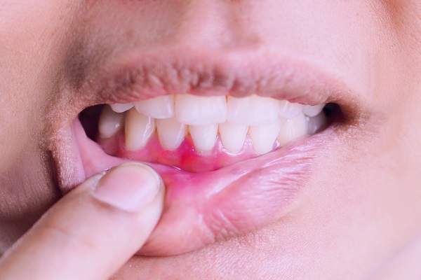 Gum Recession Treatment Explained