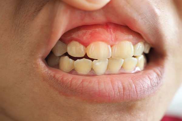 Ask A Periodontist: Are Bleeding Gums A Cause For Concern?